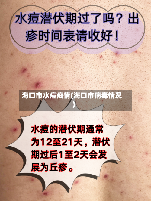 海口市水痘疫情(海口市病毒情况)-第3张图片