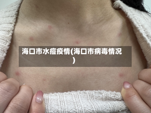 海口市水痘疫情(海口市病毒情况)-第1张图片
