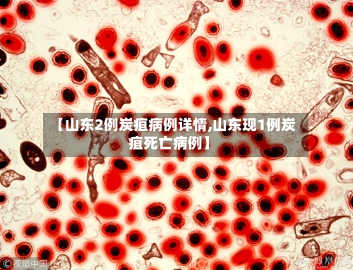 【山东2例炭疽病例详情,山东现1例炭疽死亡病例】-第1张图片