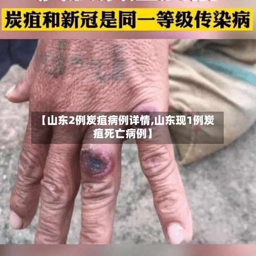 【山东2例炭疽病例详情,山东现1例炭疽死亡病例】-第2张图片