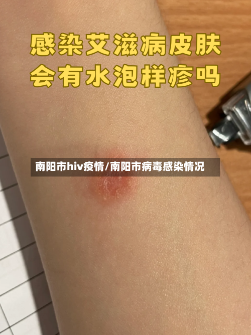 南阳市hiv疫情/南阳市病毒感染情况-第2张图片