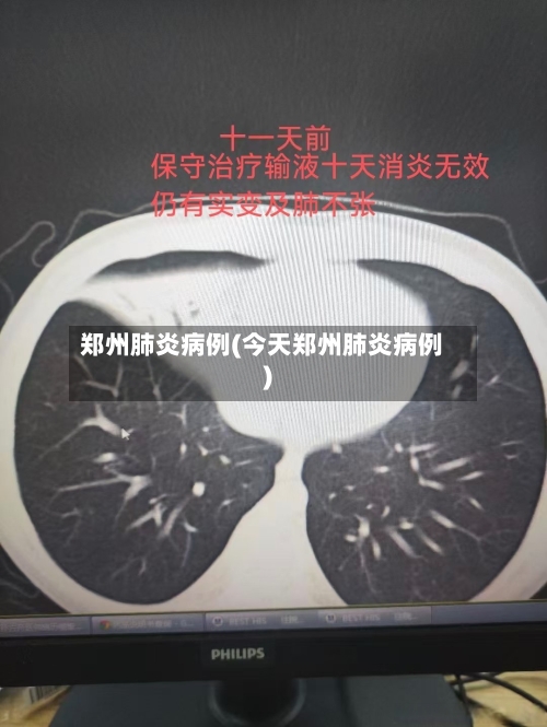 郑州肺炎病例(今天郑州肺炎病例)-第1张图片