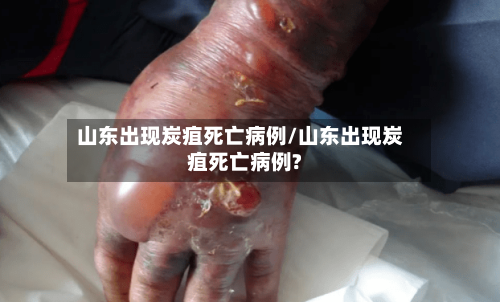山东出现炭疽死亡病例/山东出现炭疽死亡病例?-第1张图片