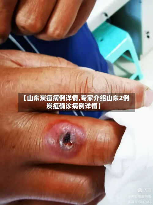 【山东炭疽病例详情,专家介绍山东2例炭疽确诊病例详情】-第3张图片