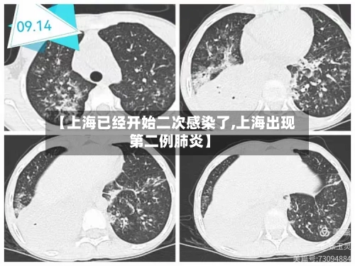 【上海已经开始二次感染了,上海出现第二例肺炎】-第2张图片