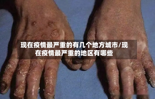 现在疫情最严重的有几个地方城市/现在疫情最严重的地区有哪些-第2张图片